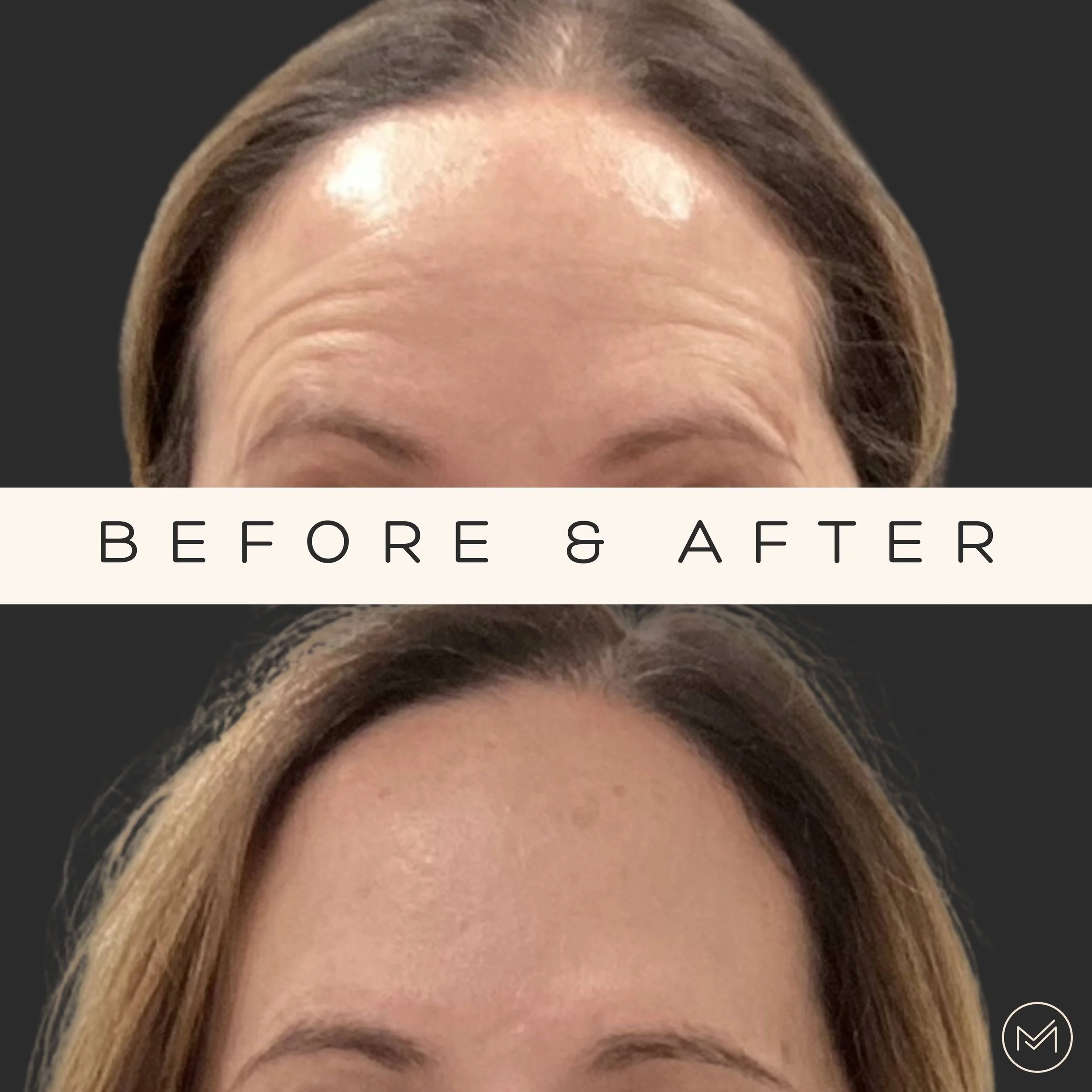 Botox Transform Your Look with Botox at Morph Med Spa in Ridgefield